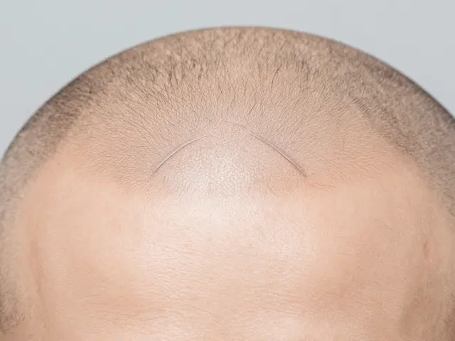 How Bald People Get Hair Extensions: Methods, Risks & Alternatives